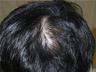 頭髪治療（薄毛、抜け毛治療）治療中（4ヵ月経過）