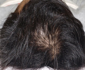 頭髪治療（薄毛、抜け毛治療）治療中（7ヵ月経過）