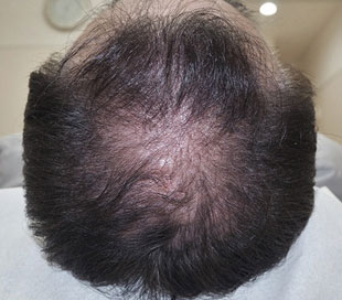 頭髪治療（薄毛、抜け毛治療）治療中（9ヵ月経過