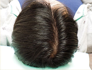 頭髪治療（薄毛、抜け毛治療）治療中（6ヵ月経過）