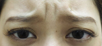 症例1　ボトックス（眉間） 施術前表情あり
