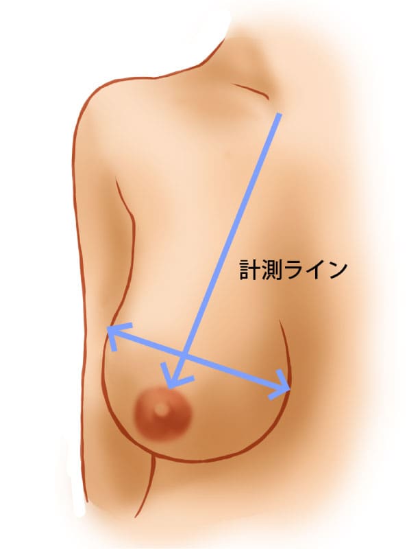 乳房縮小術（リダクション）1