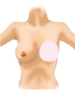乳房再建術1