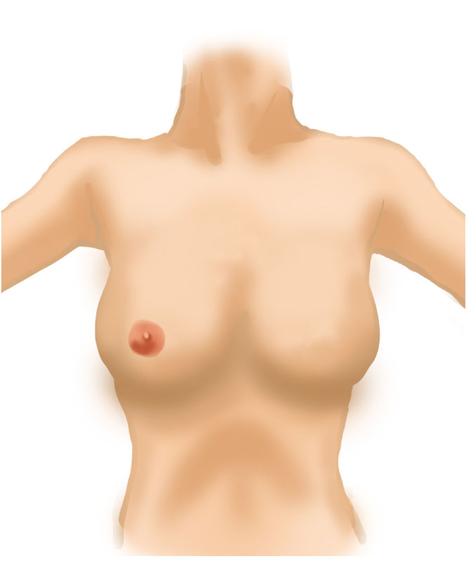 乳房再建術2