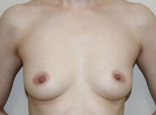 症例10　豊胸術（205ml） 手術前