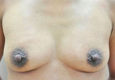 症例11　豊胸術（240ml） 手術前