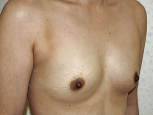 症例15　豊胸術（280ml） 手術前