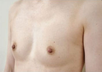 症例19　豊胸術（280ml） 手術前