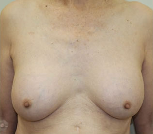 症例21　女性化を望む男性の豊胸術（200ml） 手術後