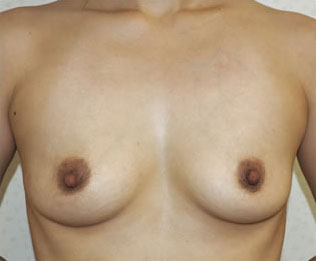 症例8　豊胸術（160ml） 手術前