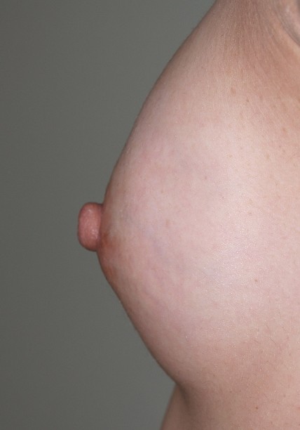 症例1　陥没乳頭修正術（左）および豊胸術（160ml） 手術後
