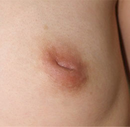 症例1　陥没乳頭修正術（左）および豊胸術（160ml） 手術前