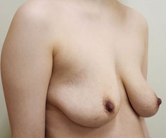 症例4　乳房吊り上げ術 手術前