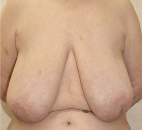 症例1　乳房縮小および乳房吊り上げ術 手術前