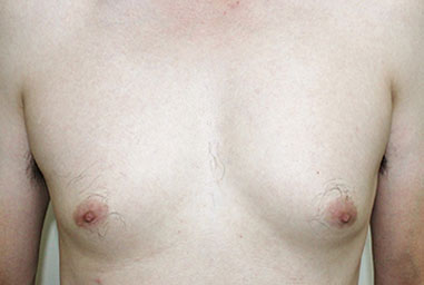 症例1　男性の女性化乳房に対する脂肪吸引 手術前