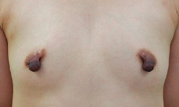 症例1　乳頭縮小・形成術（両側） 手術前