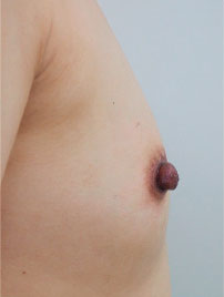 症例1　乳頭縮小・形成術（両側） 手術後（右）