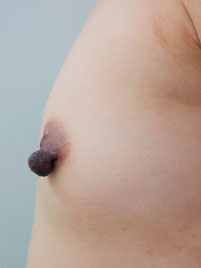 症例1　乳頭縮小・形成術（両側） 手術前（左）