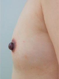 症例1　乳頭縮小・形成術（両側） 手術後（左）