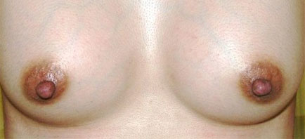 症例3　乳頭縮小・形成術（両側）および豊胸術（160ml） 手術後