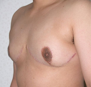 症例1　男性化希望の乳房切除術（性別適合手術）・乳頭縮小術 手術後