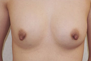 症例12　他院豊胸術後（入れ替え、インプラント破損）手術前