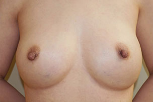 症例12　他院豊胸術後（入れ替え、インプラント破損）手術後