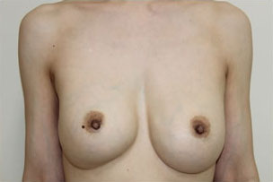 症例13　他院豊胸術後（入れ替え、被膜解除）手術前