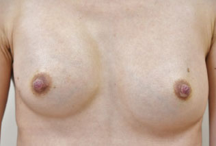 症例14　他院豊胸術後（入れ替え、被膜解除）手術前