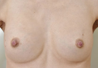 症例14　他院豊胸術後（入れ替え、被膜解除）手術後