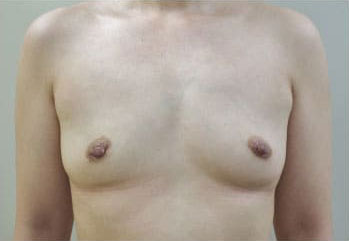 症例15　他院豊胸術後（入れ替え、インプラント破損） 手術前