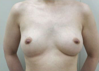 症例15　他院豊胸術後（入れ替え、インプラント破損） 手術後