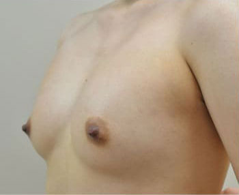 症例1　他院豊胸術後（脂肪注入後シリコン希望） 手術前