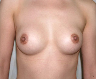 症例1　他院豊胸術後（入れ替え、被膜解除） 手術前