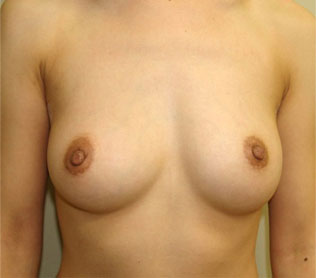 症例1　他院豊胸術後（入れ替え、被膜解除） 手術後