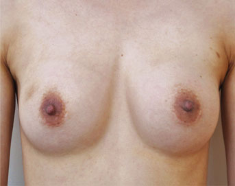 症例3　他院豊胸術後（入れ替え、被膜解除） 手術後