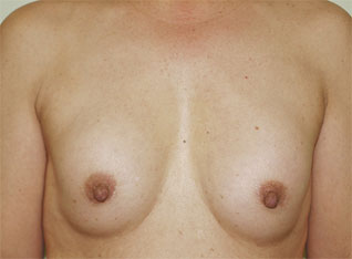 症例4　他院豊胸術後（入れ替え、被膜解除） 手術前