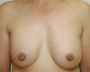 症例4　他院豊胸術後（入れ替え、被膜解除） 手術後