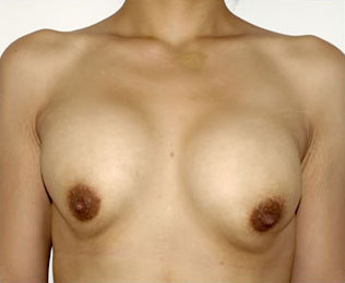 症例5　他院豊胸術後（入れ替え、被膜解除、位置異常） 手術前