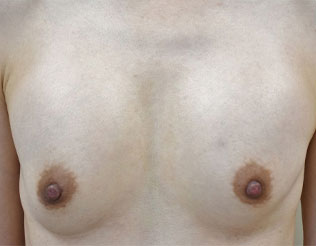 症例6　他院豊胸術後（入れ替え、位置異常） 手術前