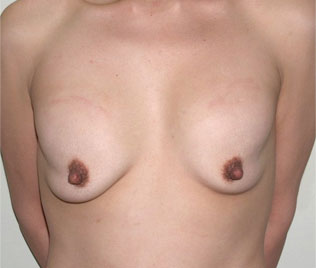 症例7　他院豊胸術後（入れ替え、被膜解除、位置異常）手術前