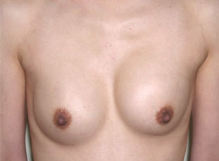 症例9　他院豊胸術後（入れ替え、位置異常） 手術前