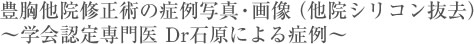豊胸他院修正術の症例写真・画像(他院シリコン抜去) ~学会認定専門医 Dr石原による症例~