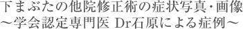 下まぶたの他院修正術の症例写真・画像〜学会認定専門医 Dr石原による症例〜