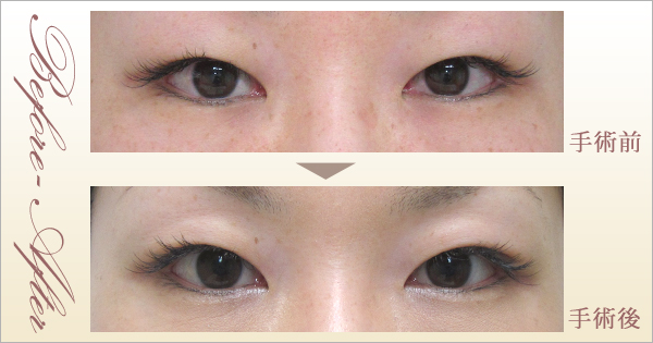 二重まぶた症例写真