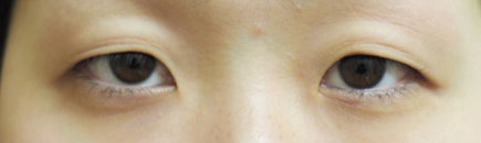 症例36　二重まぶた　切開法・眼瞼下垂 手術前