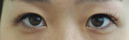 症例36　二重まぶた　切開法・眼瞼下垂 手術後
