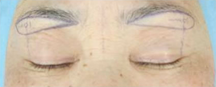 症例8　上まぶたのたるみ手術（眉毛下切開） 手術前デザイン
