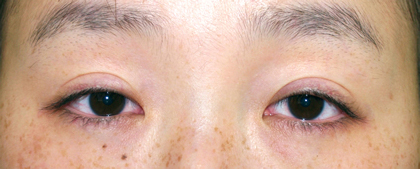 症例2　二重まぶた（切開法）・眼瞼下垂（両側）・目頭切開 手術前