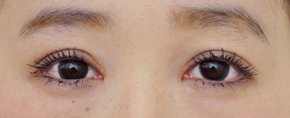 症例2　二重まぶた（切開法）・眼瞼下垂（両側）・目頭切開 手術後